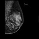 Glandular type, normal mammography, : X-ray - Plain radiograph